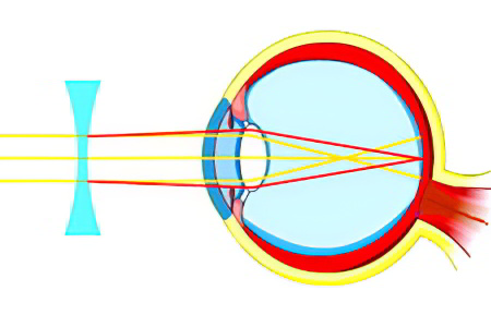 дальнозоркость дальнозоркость