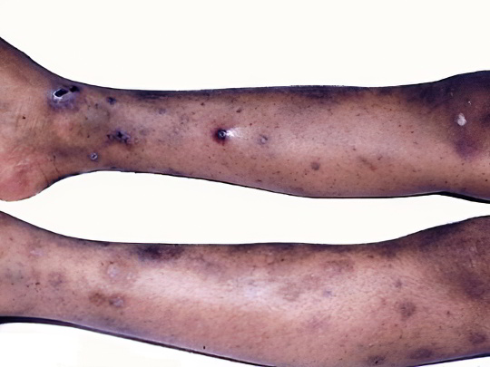 Идиопатическая (иммунная) тромбоцитопеническая пурпура Идиопатическая (иммунная) тромбоцитопеническая пурпура