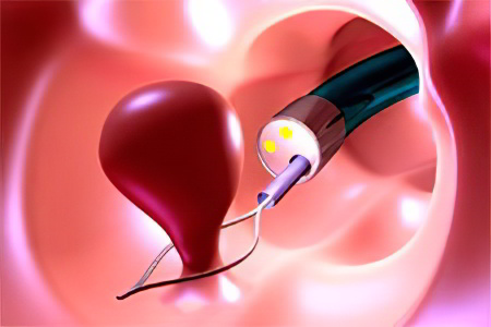 Полипы в матке Полипы в матке