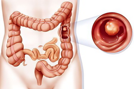 полипы полипы