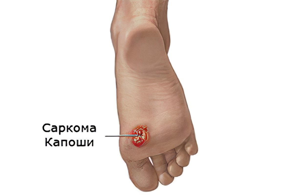 саркома Капоши саркома Капоши