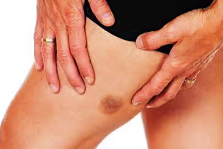 Симптомы саркомы мягких тканей Симптомы саркомы мягких тканей