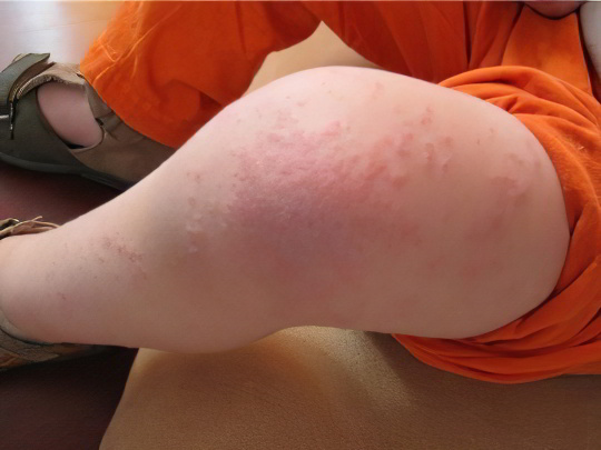 Аллергический дерматит Аллергический дерматит