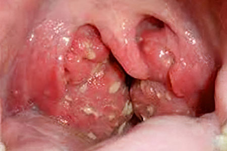 Симптомы фолликулярной ангины Симптомы фолликулярной ангины