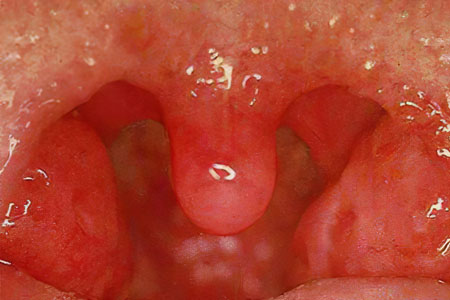Симптомы катаральной ангины Симптомы катаральной ангины