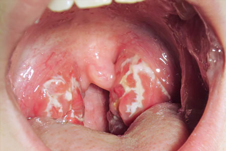 Симптомы лакунарной ангины Симптомы лакунарной ангины