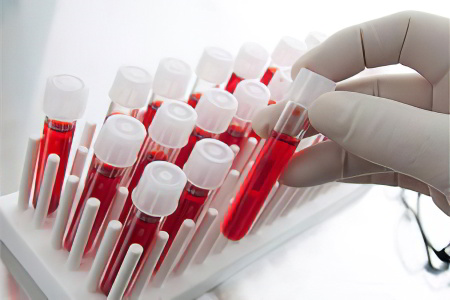 Антистрептолизин-О Антистрептолизин-О