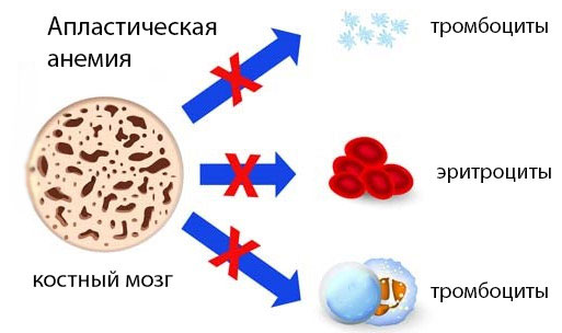 Апластическая анемия Апластическая анемия