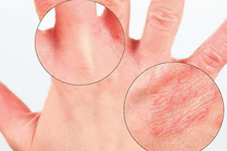 Причины псориатического артрита Причины псориатического артрита