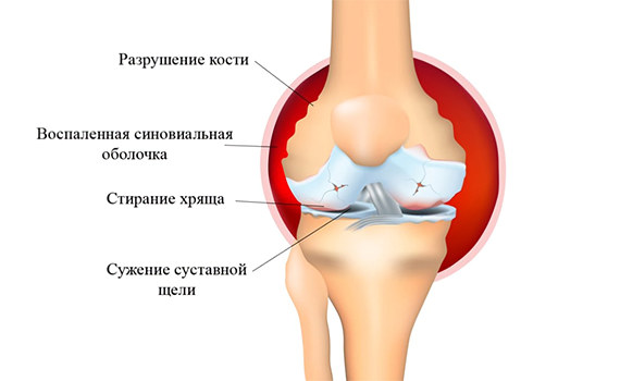 Артрит Артрит