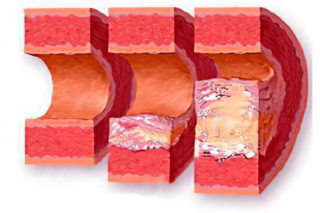 Причины атеросклероза Причины атеросклероза