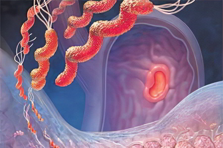 атрофический гастрит атрофический гастрит