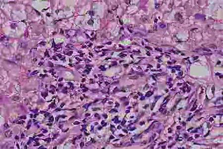 Виды аутоиммунного гепатита Виды аутоиммунного гепатита