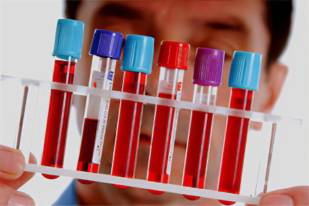 Билирубин непрямой Билирубин непрямой