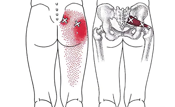 Воспаление грушевидной мышцы Воспаление грушевидной мышцы
