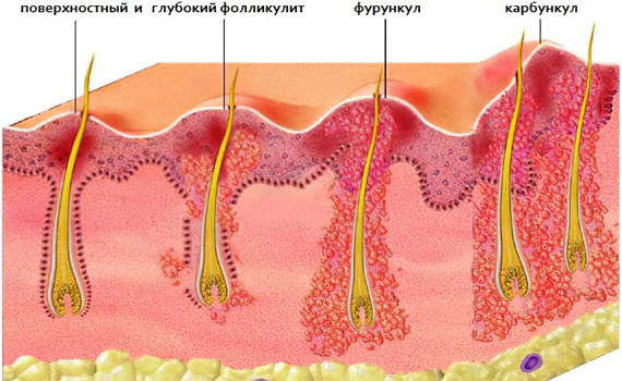 Карбункул Карбункул