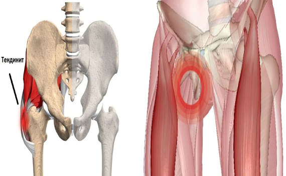 Тендинит Тендинит