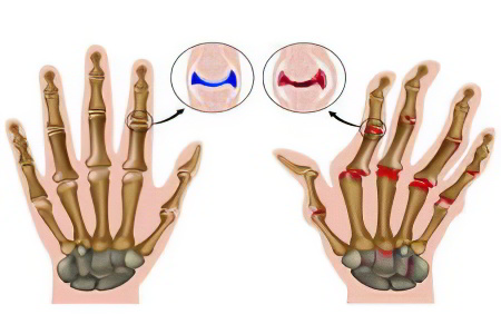 Болезнь Стилла Болезнь Стилла