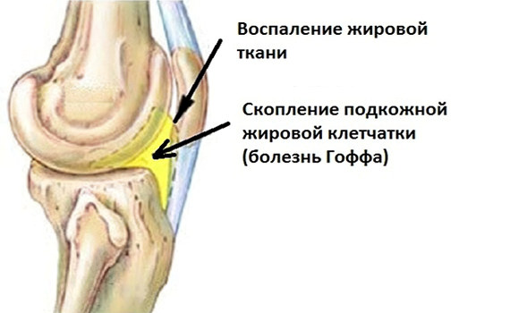 Болезнь Гоффа Болезнь Гоффа
