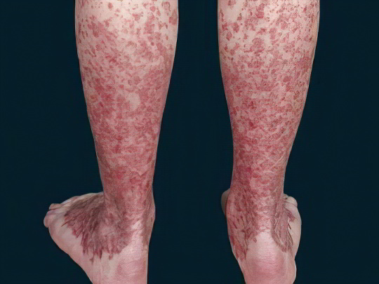 Болезнь Шамберга Болезнь Шамберга