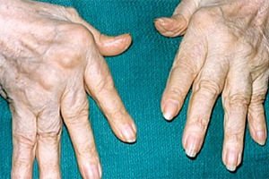 Ревматоидный артрит Ревматоидный артрит