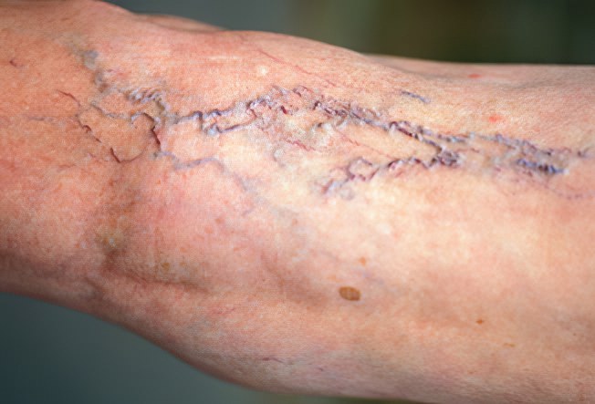 Варикозное расширение вен Варикозное расширение вен