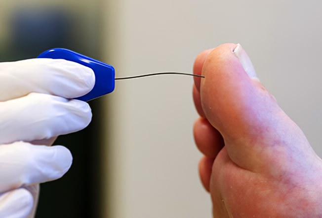 Периферическая невропатия Периферическая невропатия