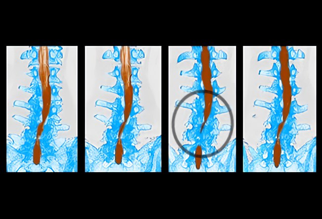 Спинальный стеноз Спинальный стеноз