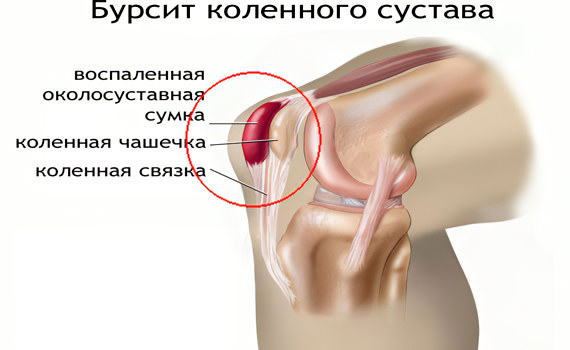 Бурсит Бурсит