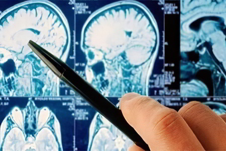 Арахноидальная киста – что это Арахноидальная киста – что это