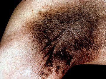 Чёрный акантоз Чёрный акантоз