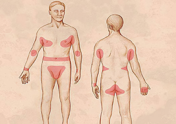 Частое расположение чесоточного клеща Частое расположение чесоточного клеща