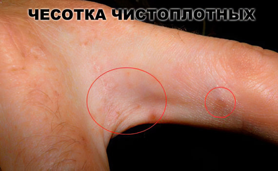 Чесотка чистоплотных Чесотка чистоплотных