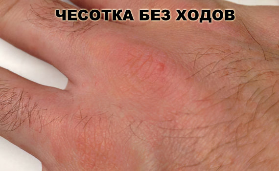 Чесотка без образования ходов Чесотка без образования ходов