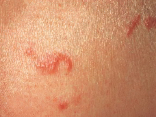 Чесотка Чесотка