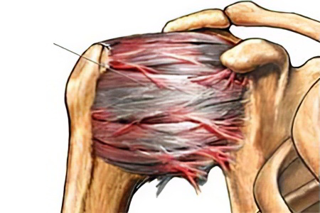 Что происходит при плечелопаточном периартрите Что происходит при плечелопаточном периартрите