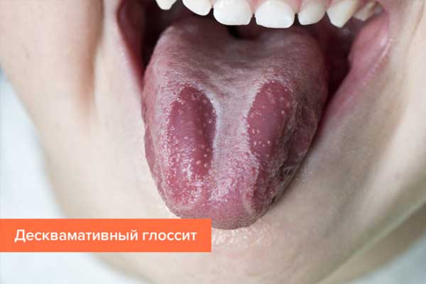 Десквамативный глоссит Десквамативный глоссит