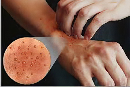 дерматит дерматит