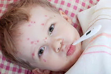 Детская почесуха Детская почесуха