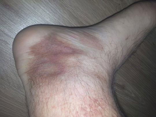 Диабетическая дермопатия Диабетическая дермопатия