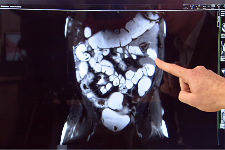 Диагностика болезни Крона Диагностика болезни Крона