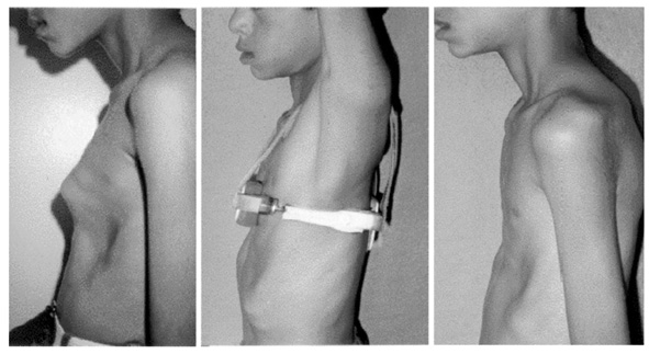 Ортезы Ортезы