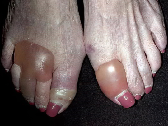 Пузырчатка Пузырчатка