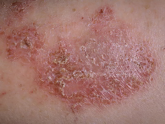 Экзема Экзема