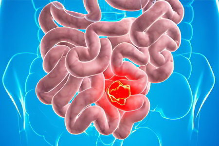 Энтерит Энтерит