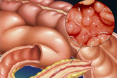 Энтерит - это опасная болезнь Энтерит - это опасная болезнь