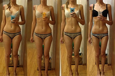 Этапы развития анорексии Этапы развития анорексии