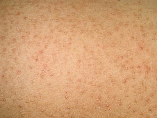 Фолликулярный кератоз Фолликулярный кератоз