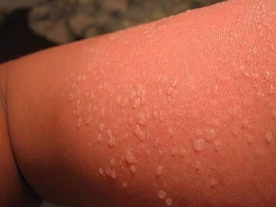 Фотодерматоз Фотодерматоз