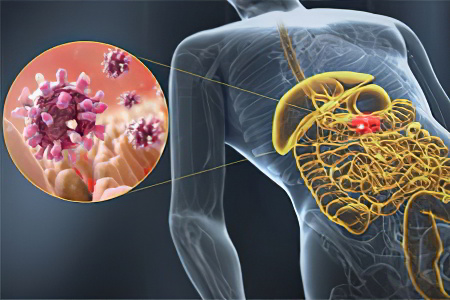 гастроэнтерит гастроэнтерит